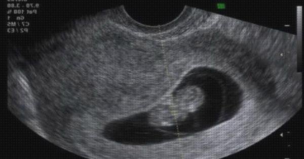 Las mejores ecografía once semanas ecografía 8 semanas niña