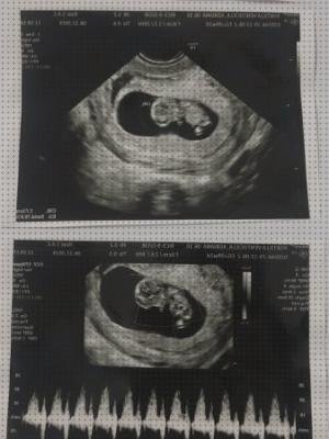 Análisis de las 14 mejores Ecografías 8 Semanas Para Niñas