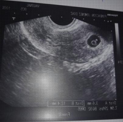 Las mejores marcas de ecografía 3 semanas embarazo ecografía once semanas ecografía 9 semanas embarazo sin latido