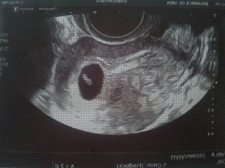 Review de ecografía 9 semanas embarazo sin latido