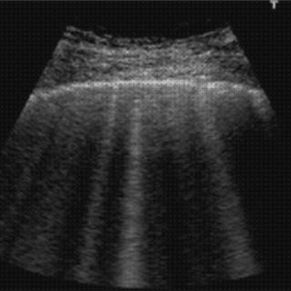 Las 20 Mejores Ecografías A Los Pulmones