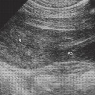 Las mejores marcas de vesical ecografía a tero vesical