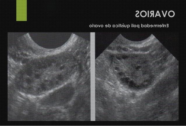 Las mejores vesical ecografía a tero vesical
