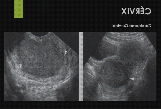 Review de ecografía a tero vesical