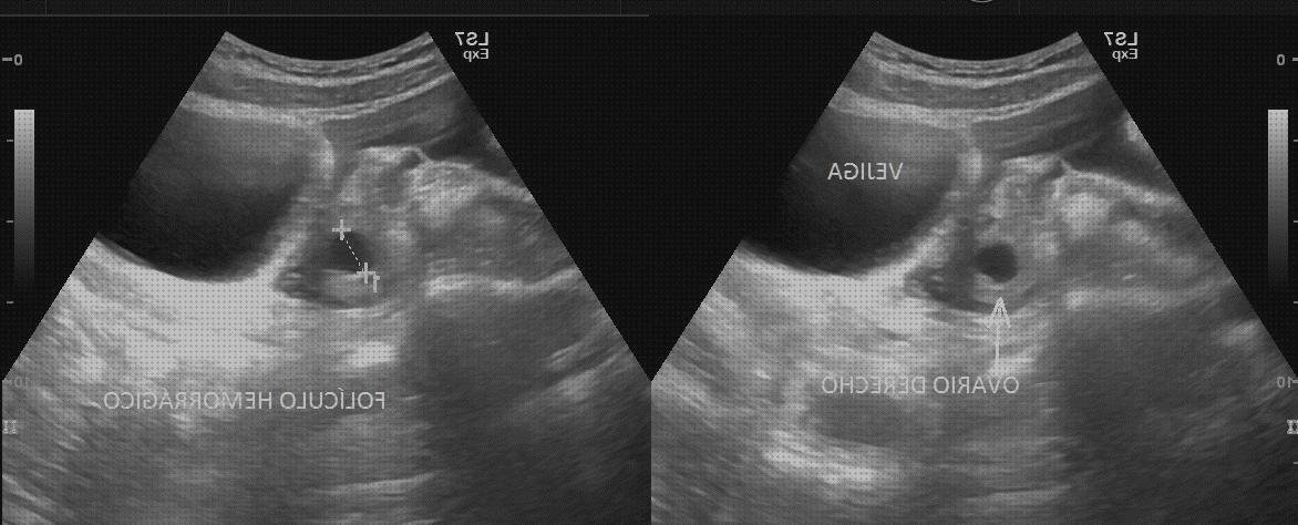 Las mejores ecografía abdominal ecografías ecografía abdominal a pie de cama