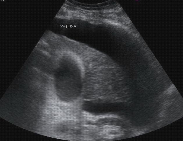 Análisis de las 7 mejores Ecografías Abdominales Higado Cirrótico Ascitis Colelitiasis