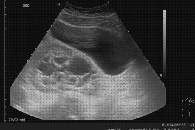 Las mejores higado ecografía abdominal higado cirrótico ascitis colelitiasis