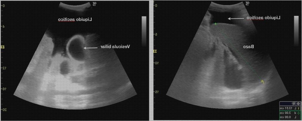 Review de ecografía abdominal higado cirrótico ascitis colelitiasis