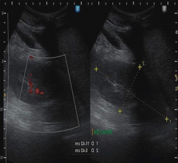 Las 9 Mejores Ecografías Abdominales Higado Cirrótico