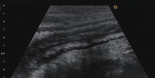 Las mejores marcas de ecografía abdominal intestinos