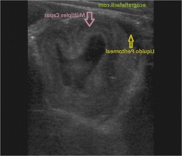 Review de ecografía abdominal intestinos