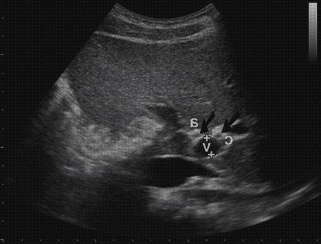 Las mejores via ecografía abdominal via biliar normal