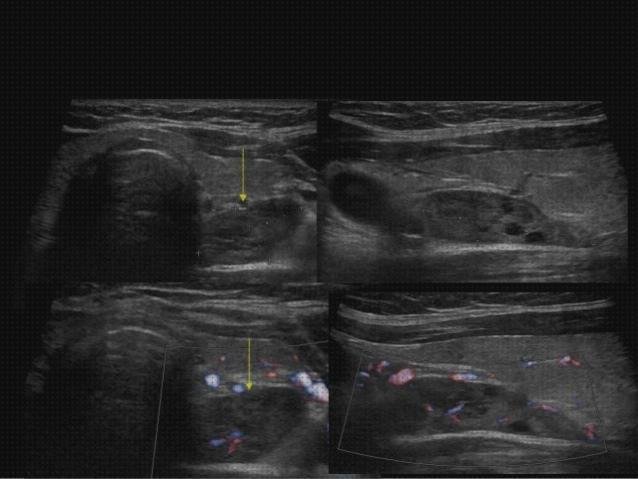 Las mejores adenoma ecografía adenoma paratiroides