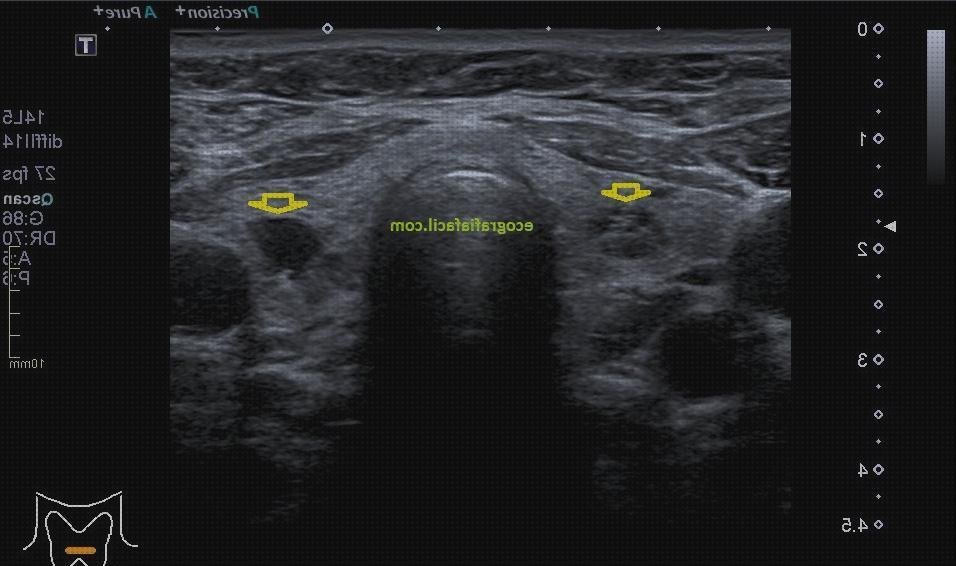 Review de ecografía adenoma paratiroides