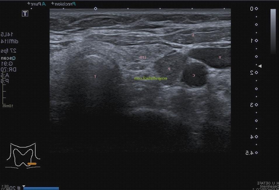 Las 4 Mejores Ecografías Adenoma Paratiroides