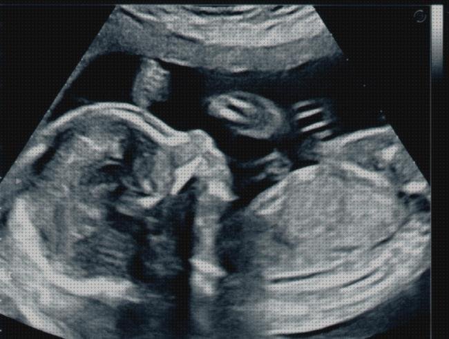 Análisis de las 10 mejores Ecografías Para Bebes Cortes De Mangas