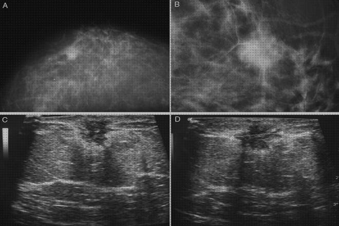 Análisis de las 8 mejores Ecografías Cancer Inflamatorios De Mamas