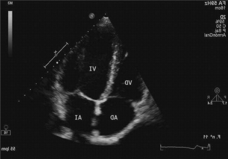Las 13 Mejores ecografías cardiacas