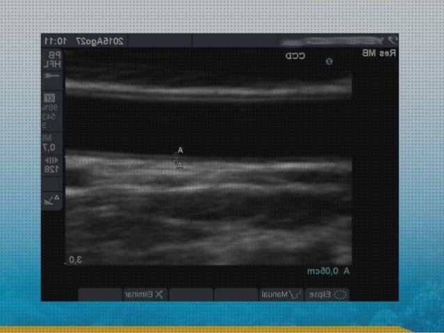 Las mejores ecografía carotídea gimc