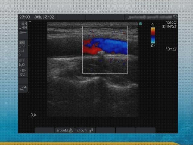 Review de ecografía carotídea gimc