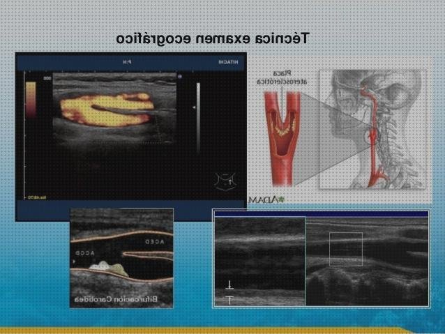 Las mejores 5 Ecografías Carotídea Gimc