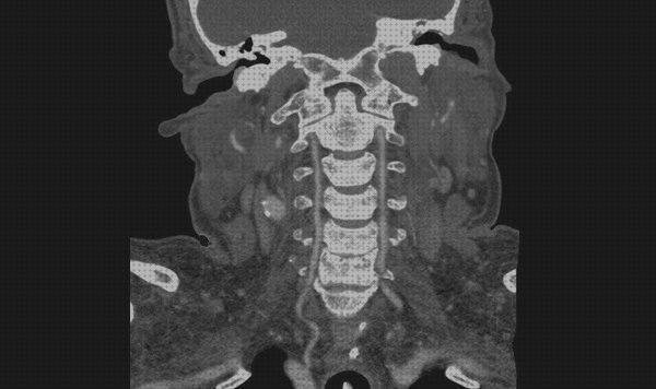 Las mejores contraste ecografía con contraste cervical