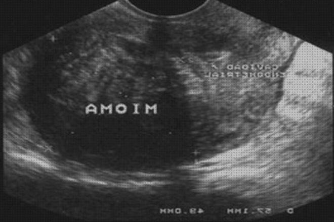 ¿Dónde poder comprar medición de la tensión arterial con tensiómetro digital Mas esterilizacion fonendoscopio Mas termómetro thermoval ecografía con miomas y mediciones?