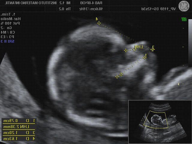 Las mejores Mas ecografía 12 semanas niño niña ecografía once semanas ecografía de 12 semanas de gestación