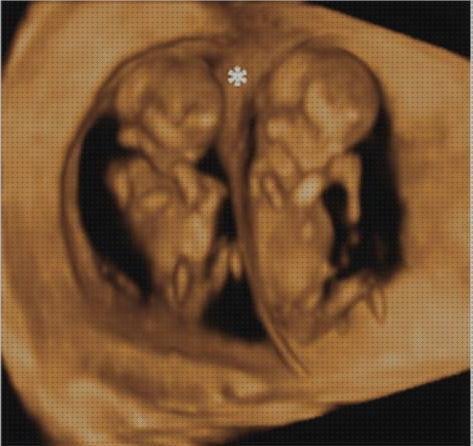 Review de ecografía de 12 semanas de gestación