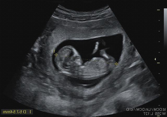¿Dónde poder comprar Mas ecografía 12 semanas niño niña ecografía once semanas ecografía de 12 semanas embarazo?