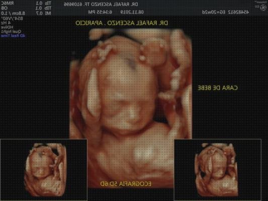 Review de ecografía de 20 semanas 5d