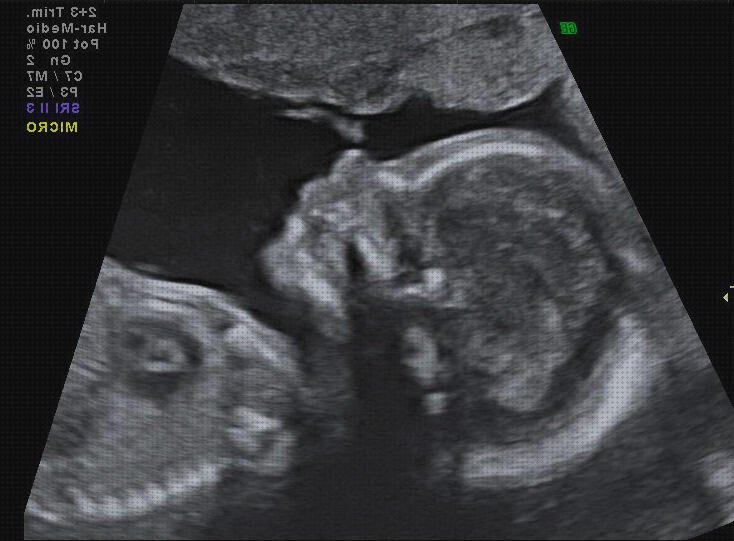 Las mejores ecografía 28 semanas niña ecografía once semanas ecografía de 28 semanas de embarazo
