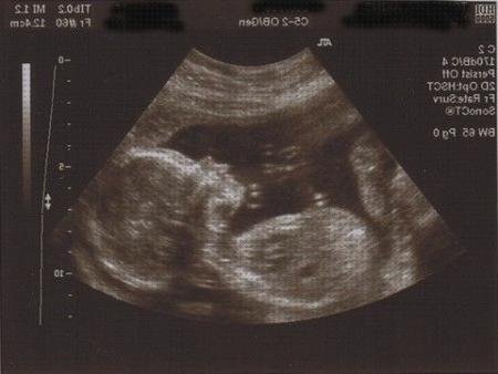 ¿Dónde poder comprar ecografía once semanas ecografía de chico 20 semanas?