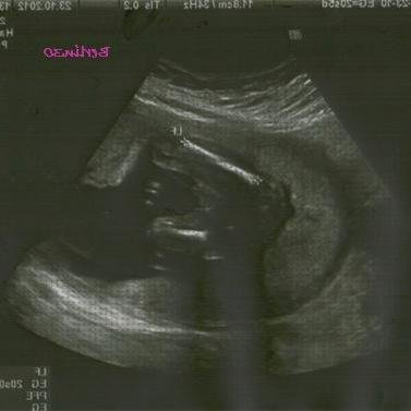 Review de ecografía de chico 20 semanas