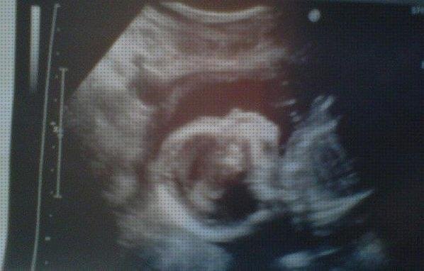 Las mejores 7 Ecografías De Chicos 20 Semanas