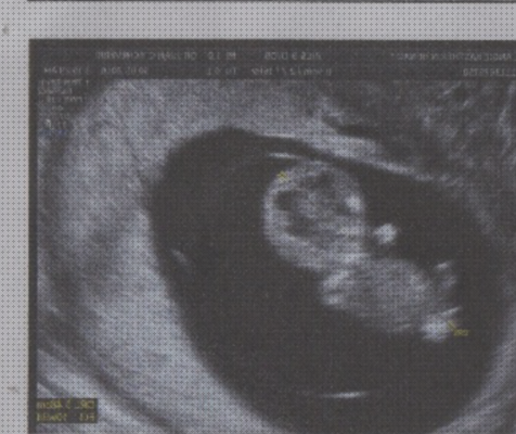 ¿Dónde poder comprar semanas ecografía de dos semanas?