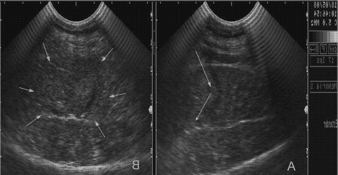 Las mejores marcas de semanas ecografía de dos semanas