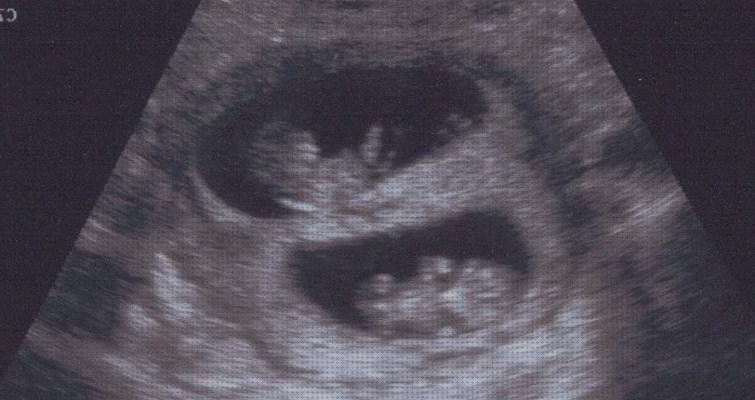 ¿Dónde poder comprar ecografía dos meses ecografía de gemelos de 3 meses?