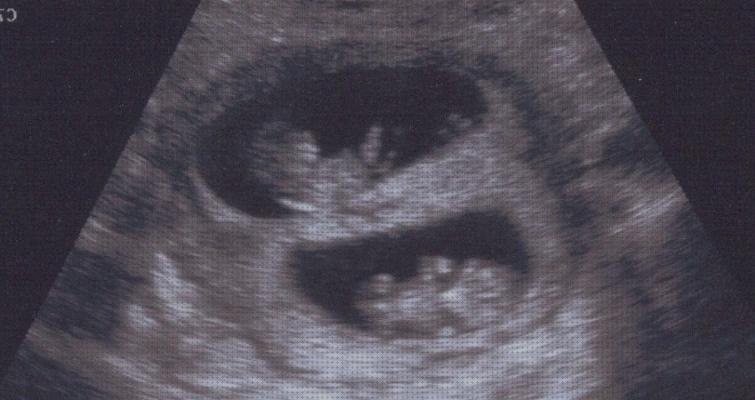 Las mejores ecografía dos meses ecografía de gemelos de 3 meses