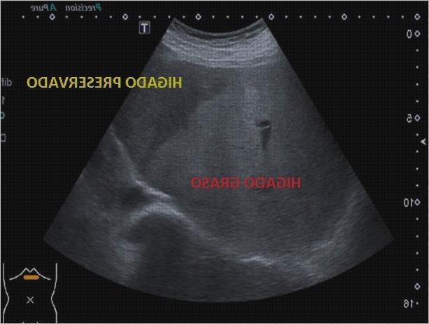 Review de ecografía de hígado patologías