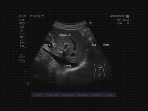 ¿Dónde poder comprar ecografía yugular ecografías ecografía de la vena cava inferior?