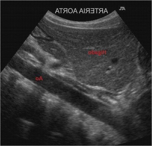 Las mejores ecografía yugular ecografías ecografía de la vena cava inferior