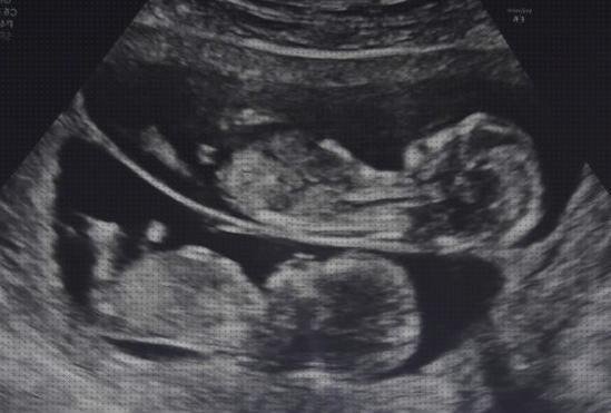 ¿Dónde poder comprar ecografía dos meses ecografía de mellizos de 5 meses?