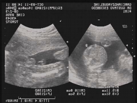 Review de ecografía de mellizos de 5 meses