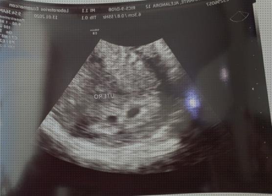 Las mejores 13 Ecografías De Mellizos De 5 Meses