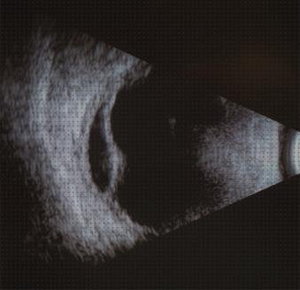 ¿Dónde poder comprar coroideo ecografía desprendimiento coroideo?