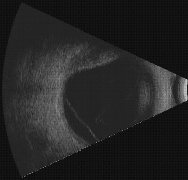 Las mejores coroideo ecografía desprendimiento coroideo