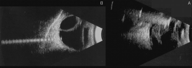 Opiniones de coroideo ecografía desprendimiento coroideo