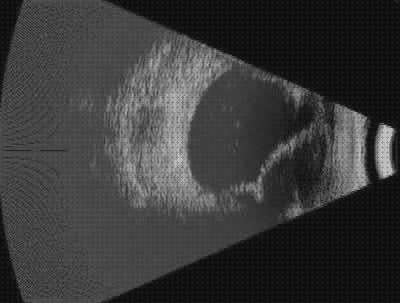 Análisis de las 6 mejores Ecografías Desprendimientos Coroideo