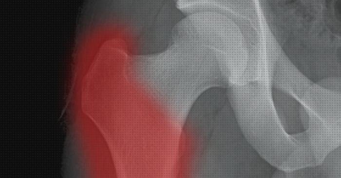 Las mejores diagnostico ecografía diagnostico trocanteritis